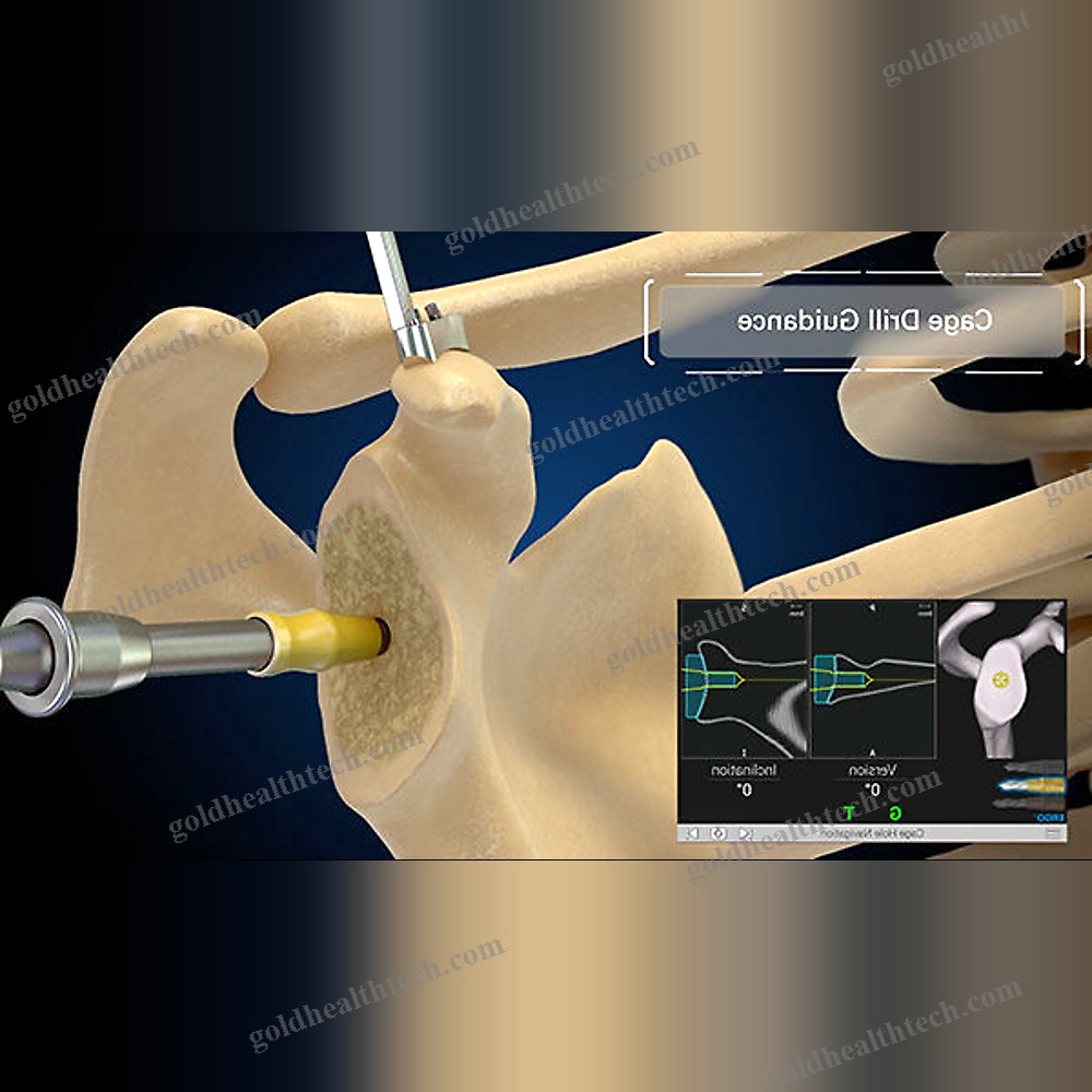 Shoulder Prosthesis Positioning Surgical Navigation System