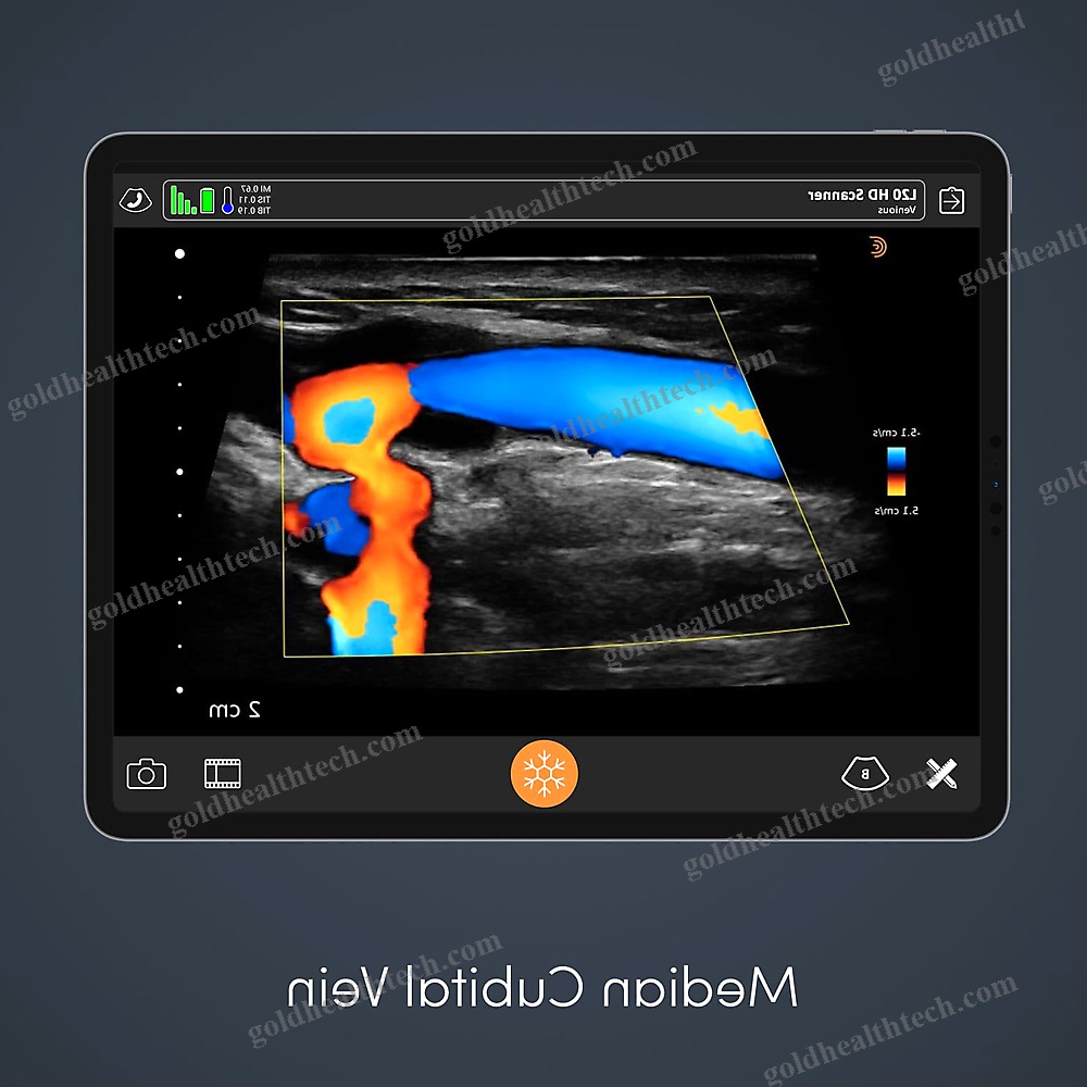 Hand-Held Ultrasound System
