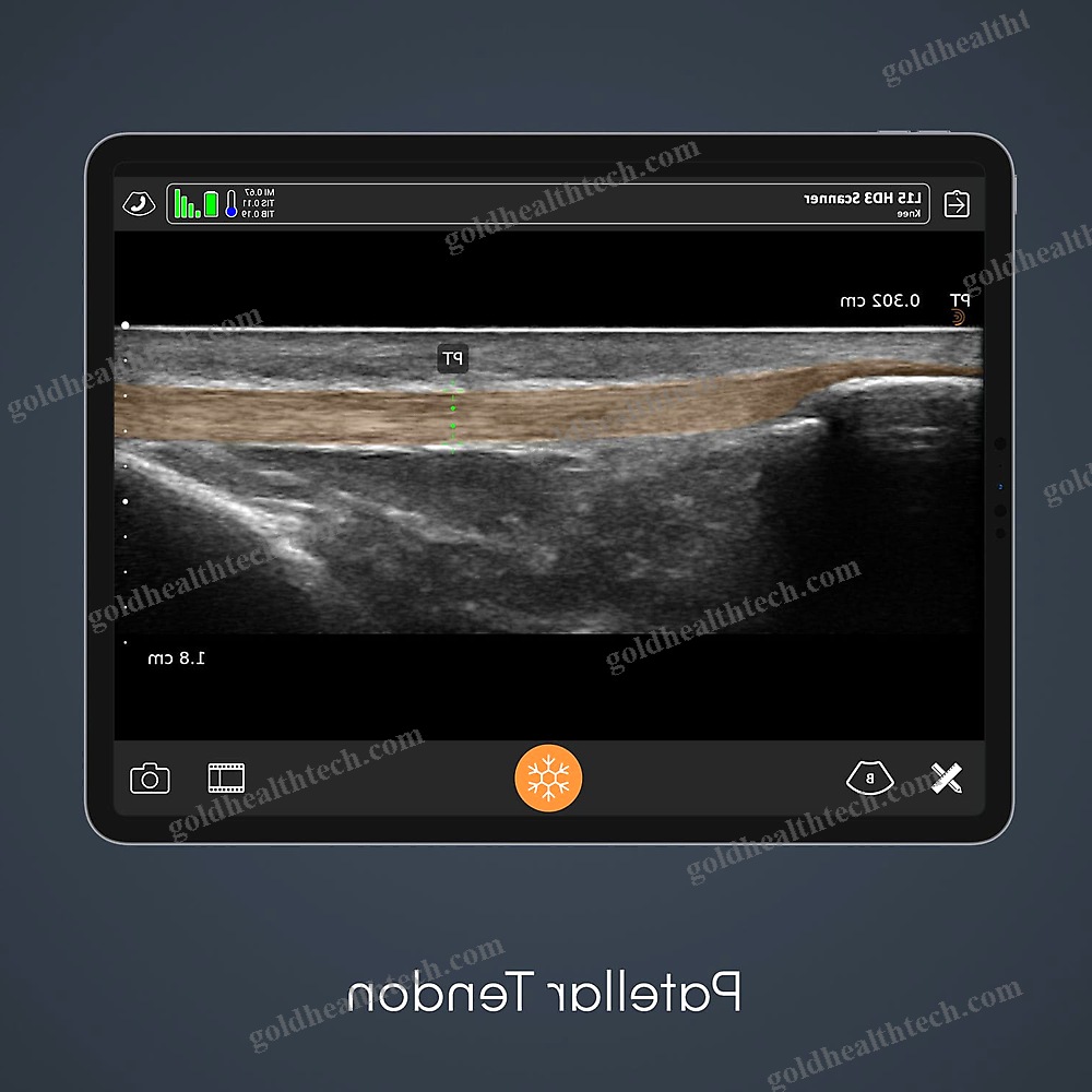 Hand-Held Ultrasound System