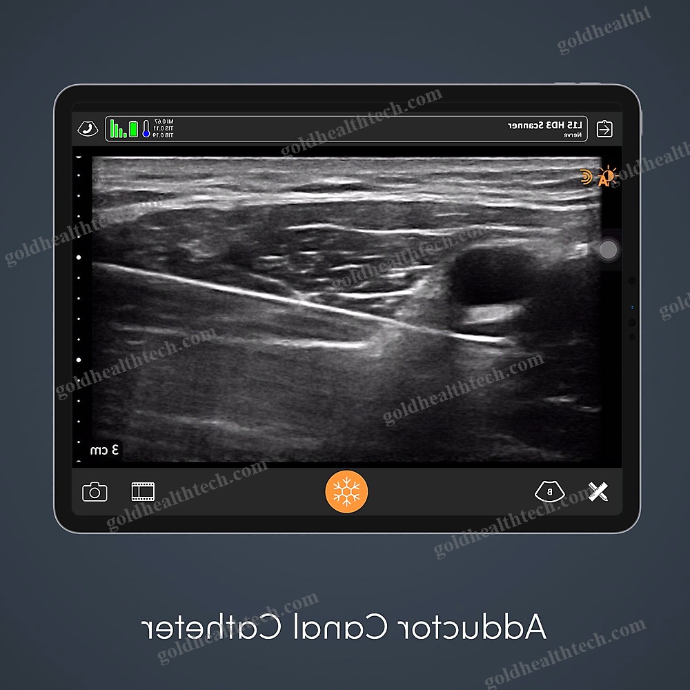 Hand-Held Ultrasound System
