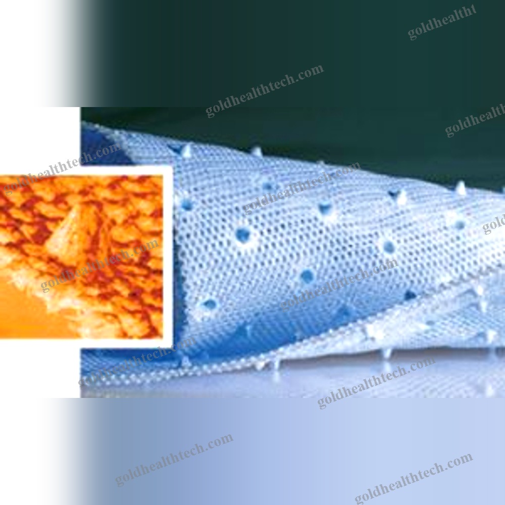 Incisional Hernia Prosthesis