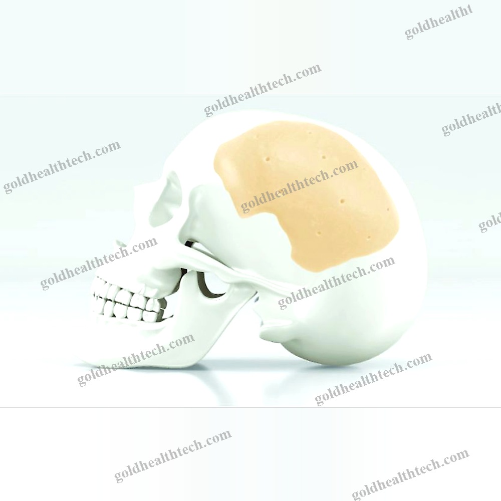 Custom-Made Cranial Implant