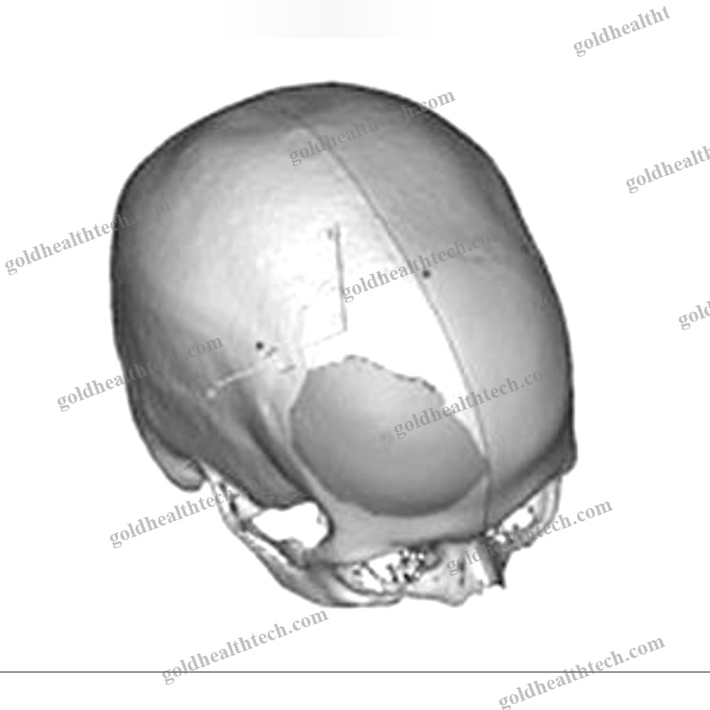 Custom-Made Cranial Implant