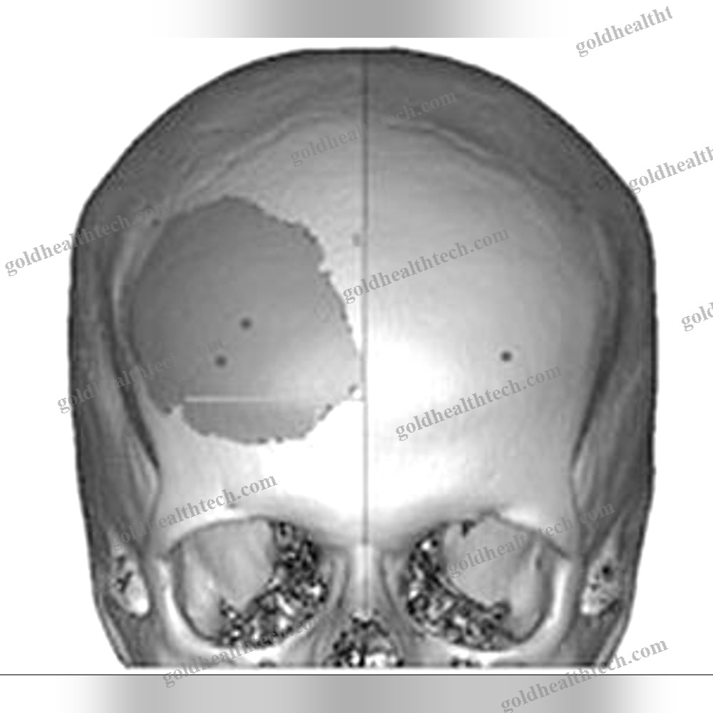 Custom-Made Cranial Implant