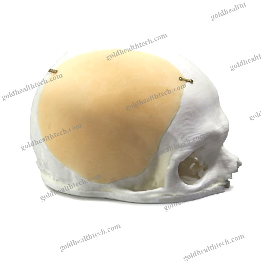 Custom-Made Cranial Implant