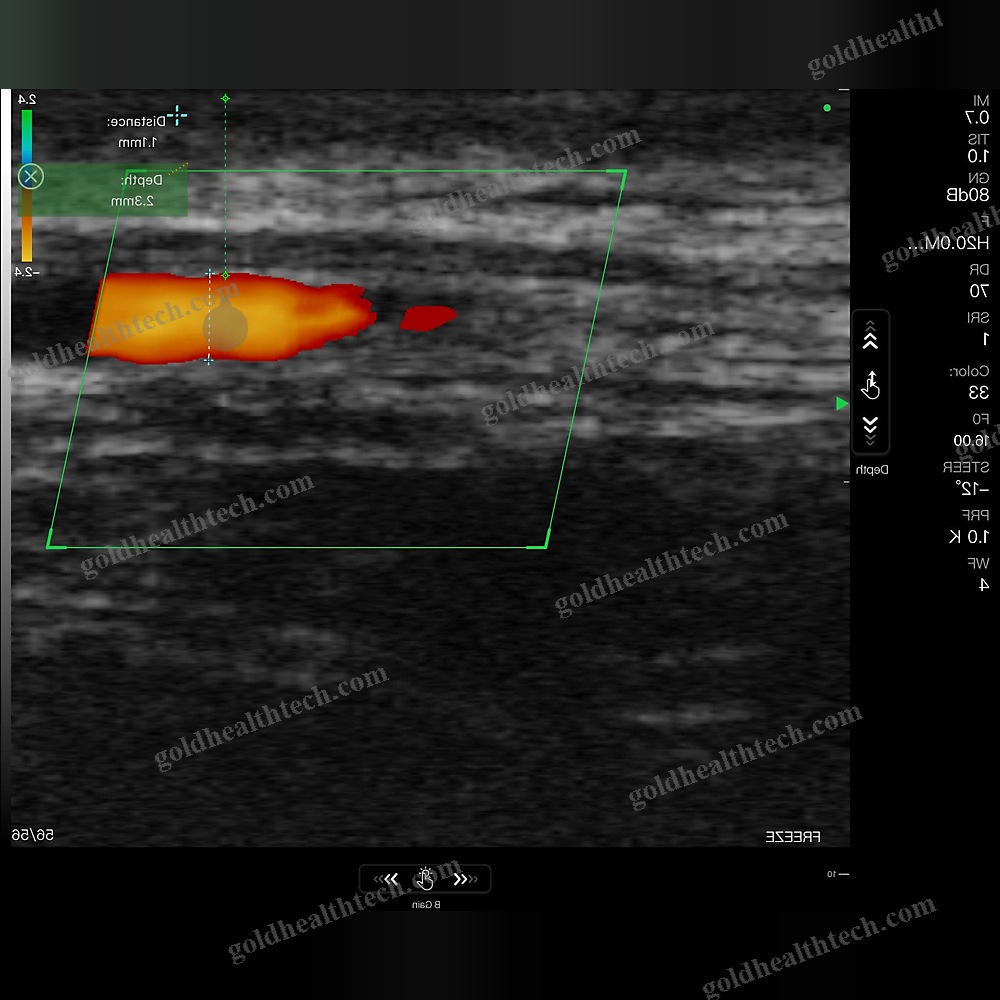 Hand-Held Ultrasound System