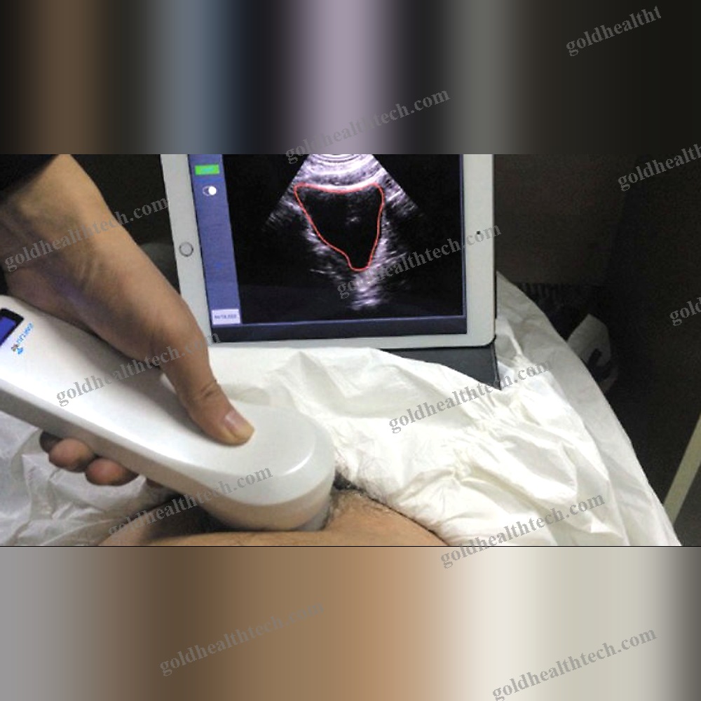 Hand-Held Bladder Scanner