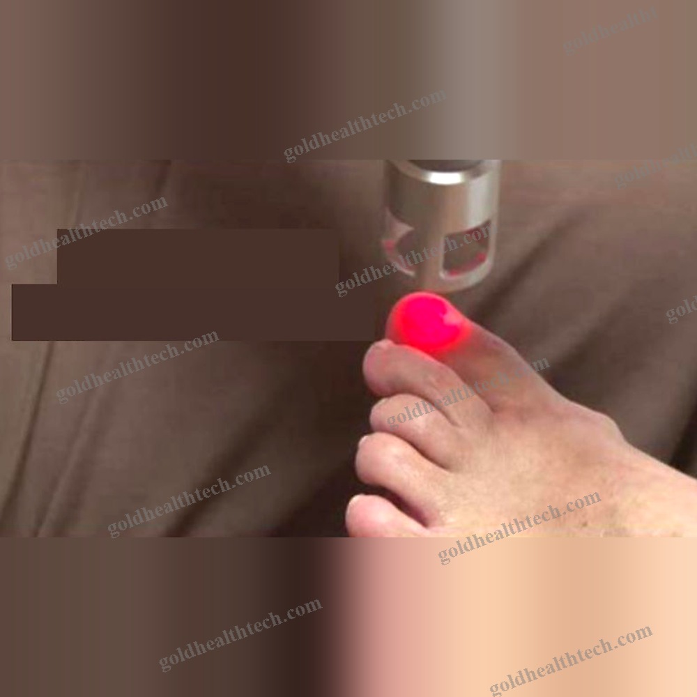Onychomycosis Treatment Laser