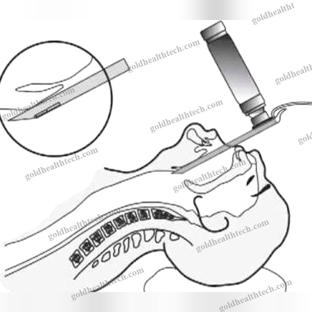 Video Laryngoscope With Integrated Video Monitor