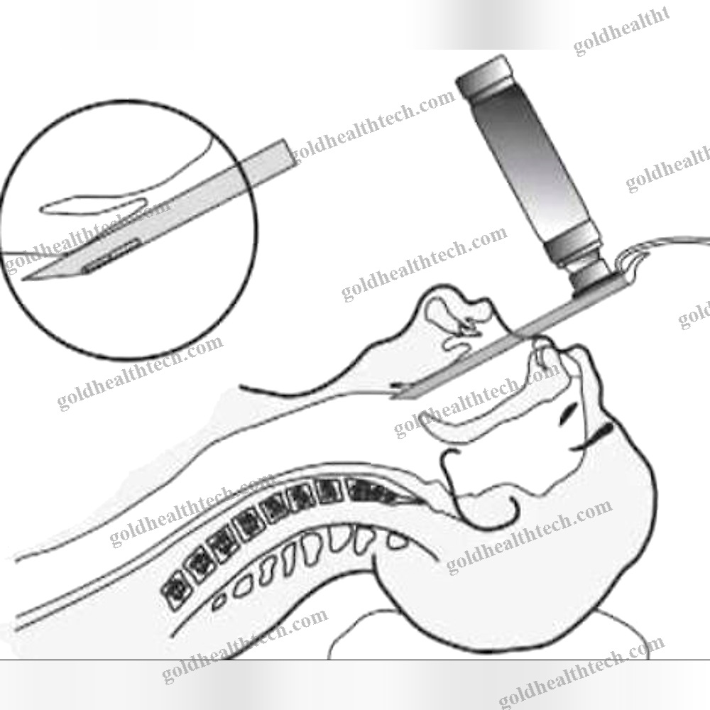 High-Definition Video Laryngoscope