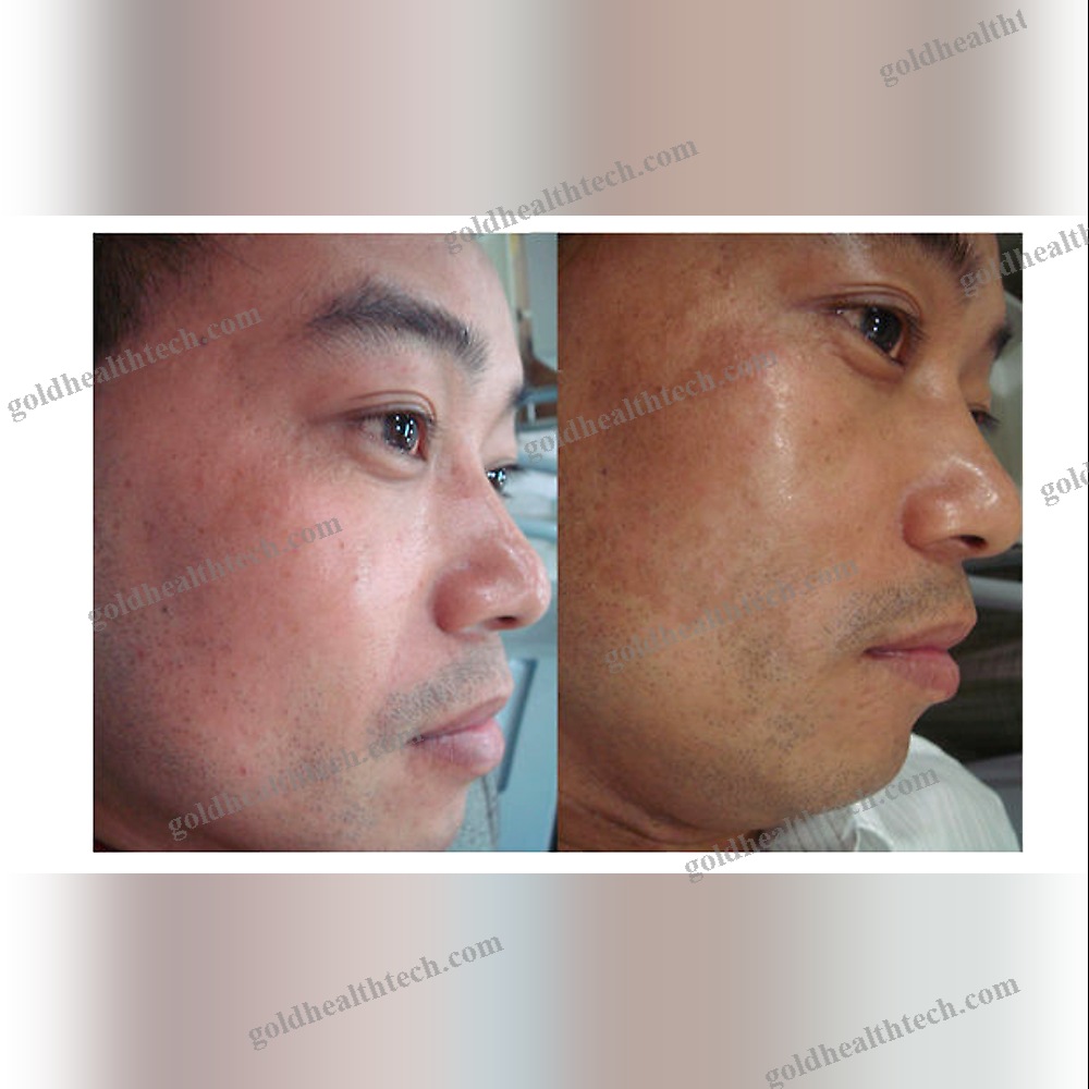 Skin Rejuvenation Laser