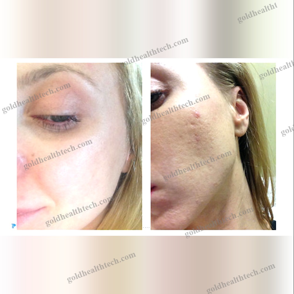 Skin Rejuvenation Laser