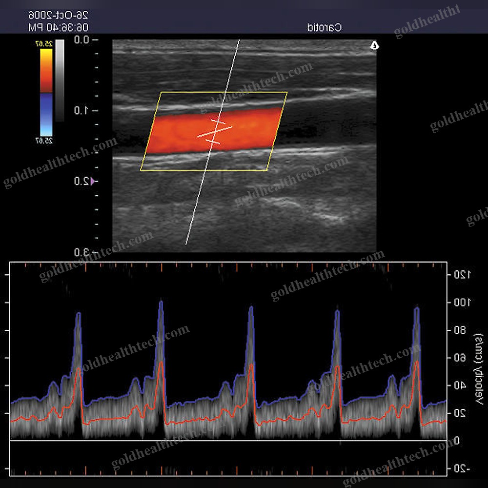 Portable Ultrasound System
