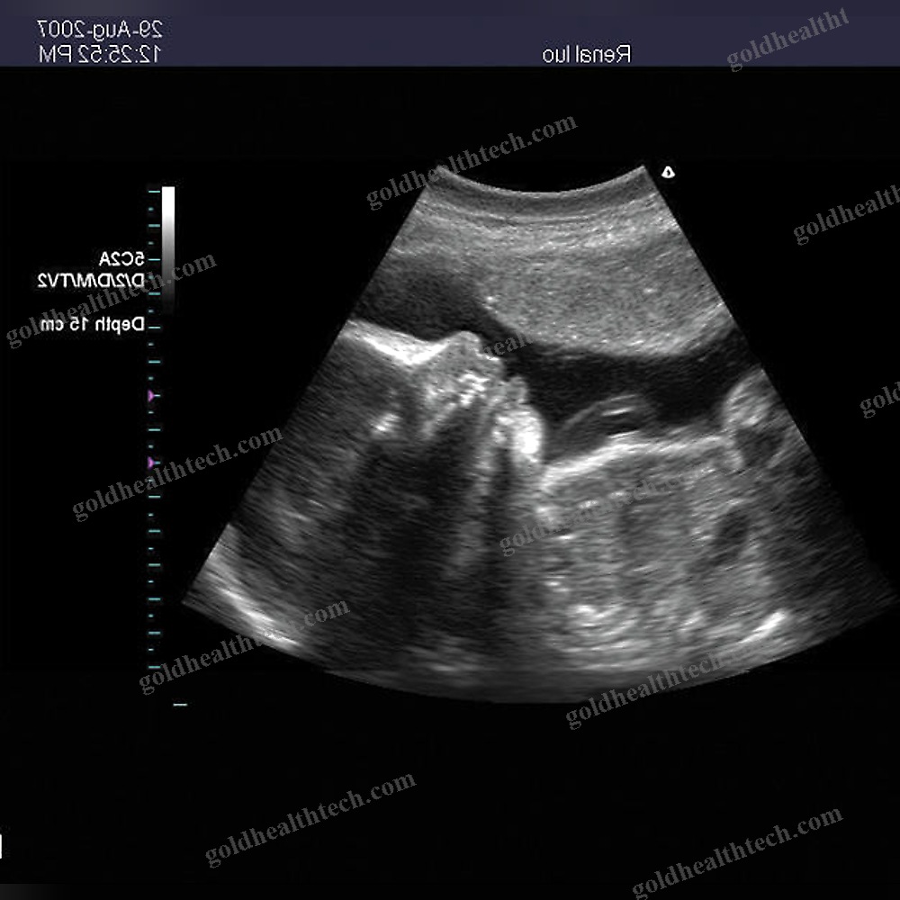 Portable Ultrasound System