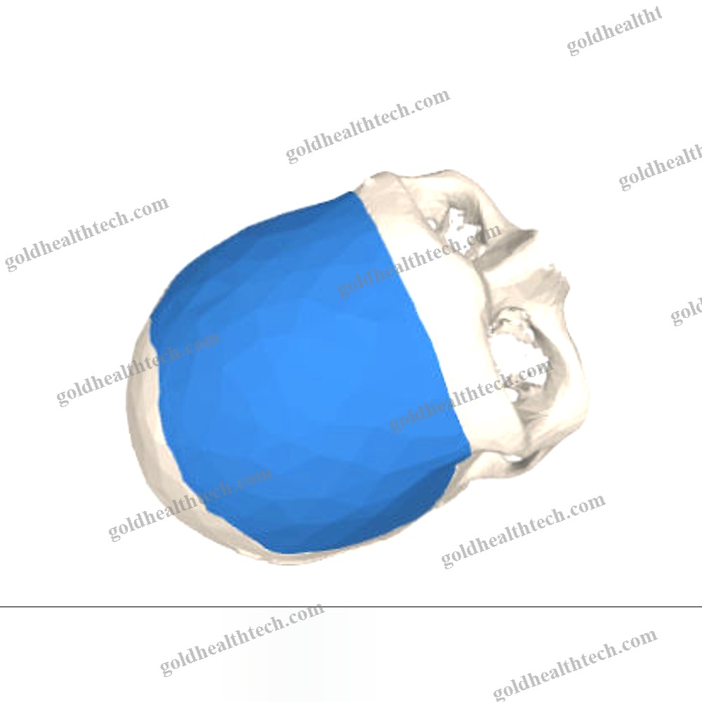 Custom-Made Cranial Implant