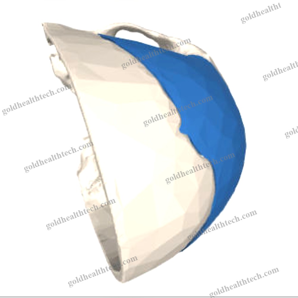 Custom-Made Cranial Implant