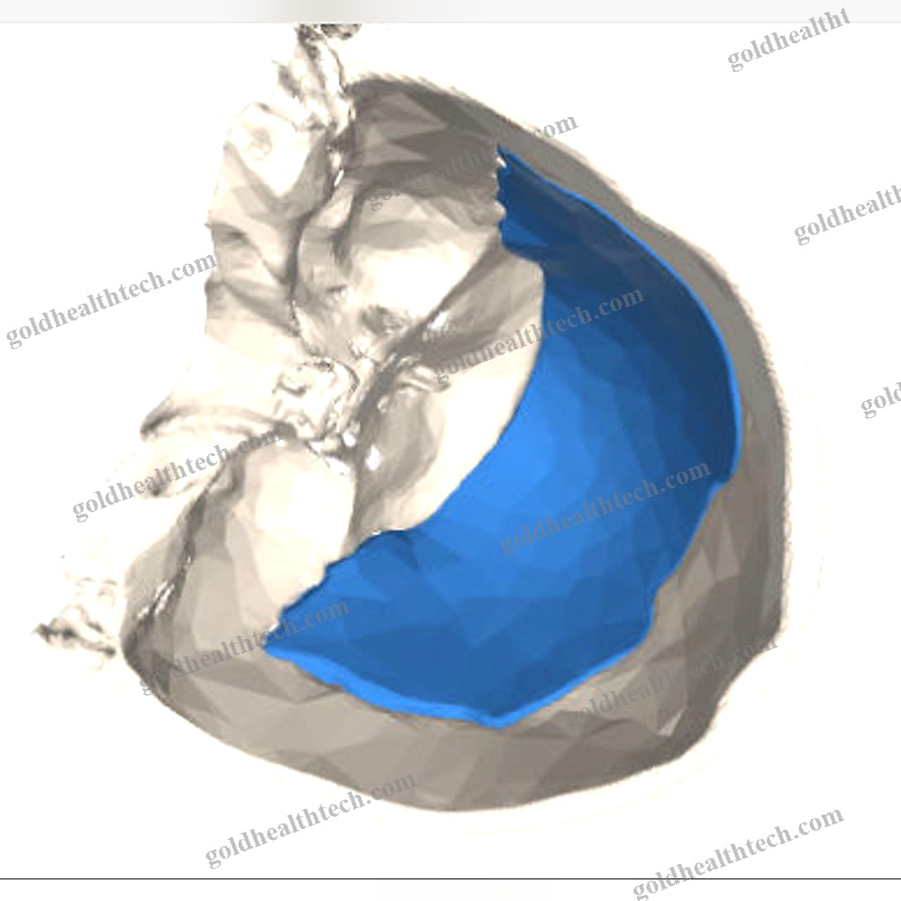 Custom-Made Cranial Implant