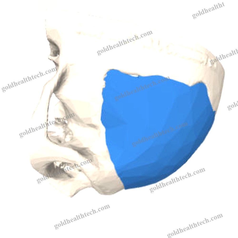 Custom-Made Cranial Implant