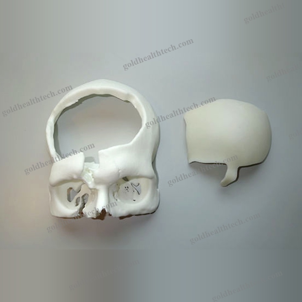 Custom-Made Cranial Implant