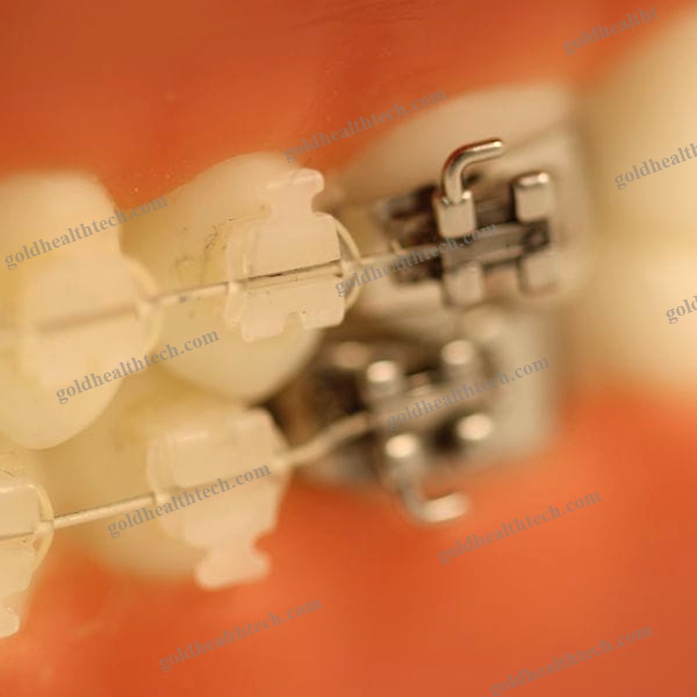 Aesthetic Orthodontic Bracket