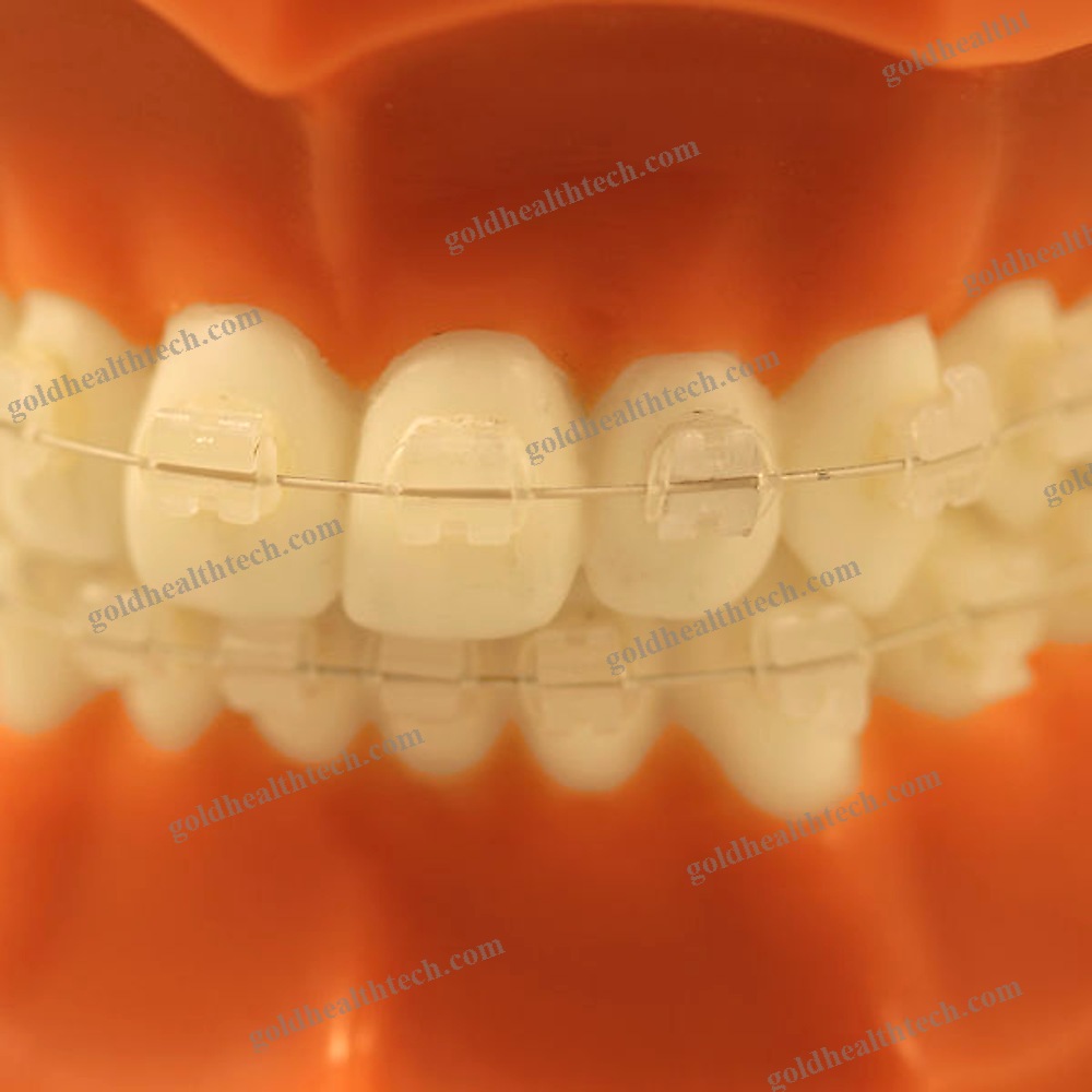Aesthetic Orthodontic Bracket