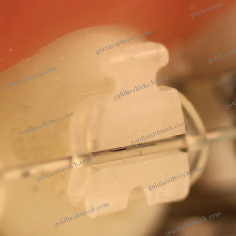 Aesthetic Orthodontic Bracket