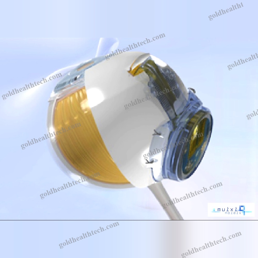 Epiretinal Implant