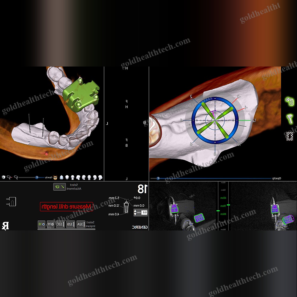 Dental Surgery Surgical Navigation System