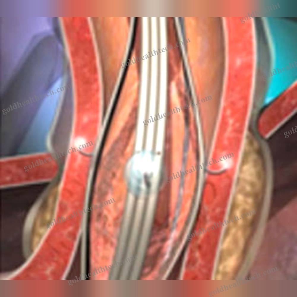 Gerd Treatment Endoscopic Surgical System