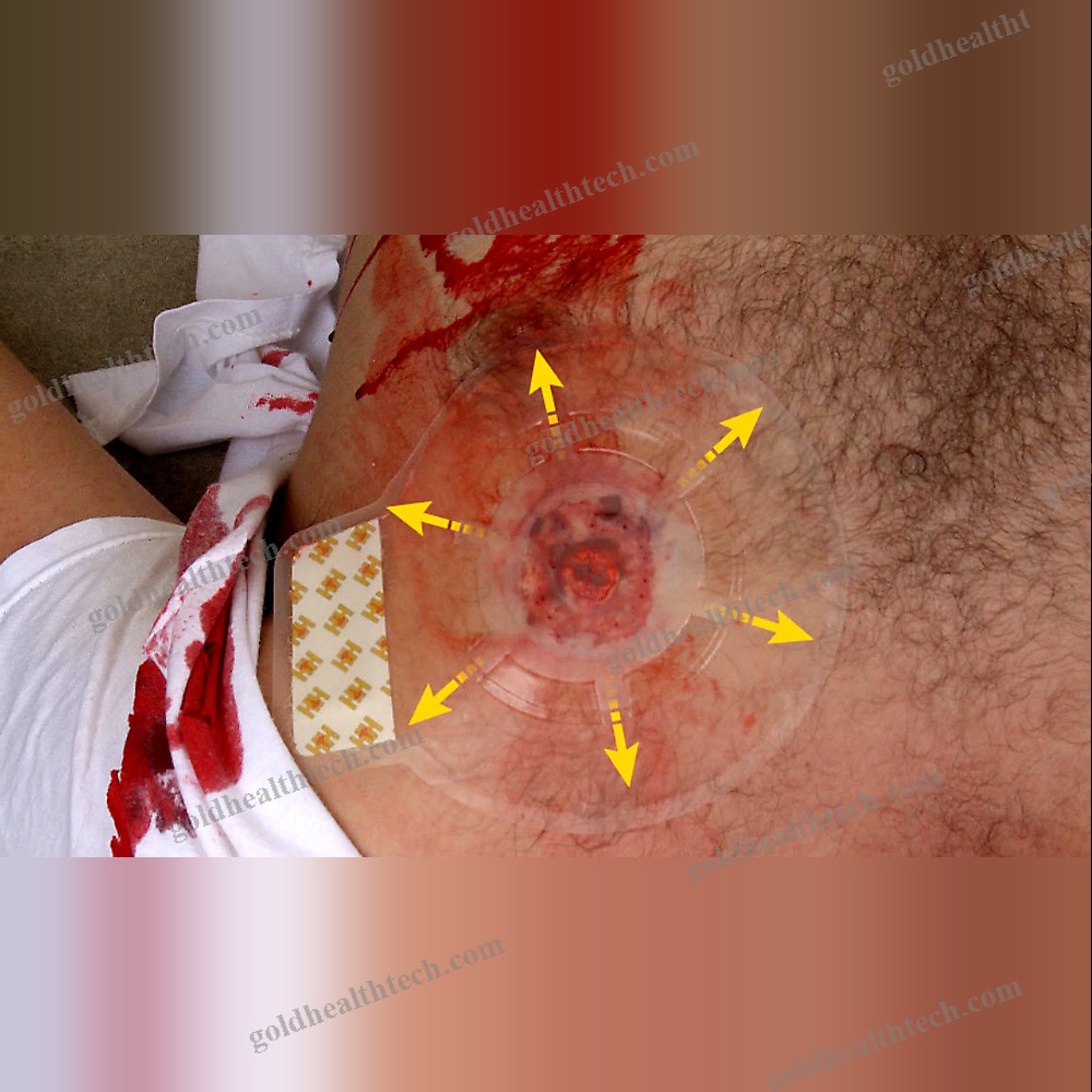 Wound Dressing