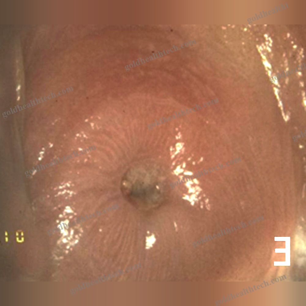 Ent Surgery Laser