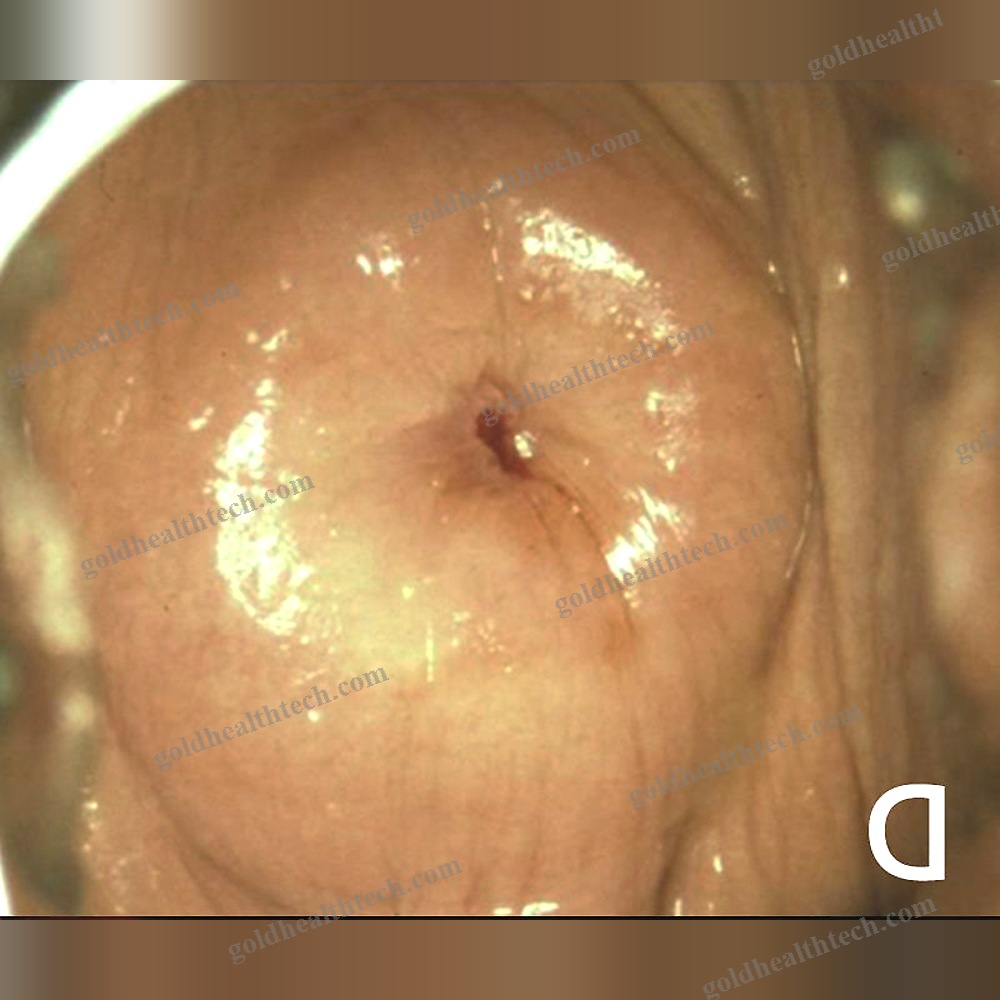 Ent Surgery Laser
