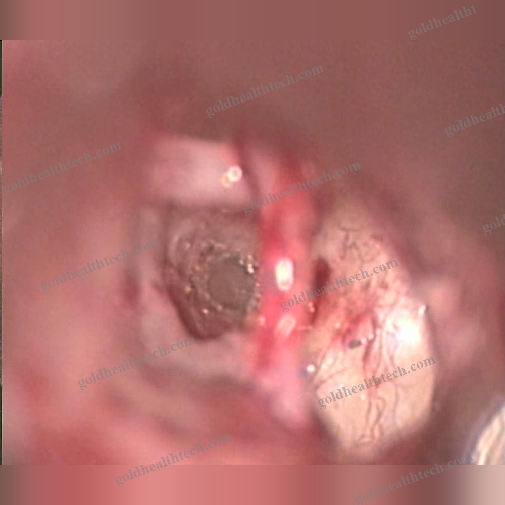 Ent Surgery Laser