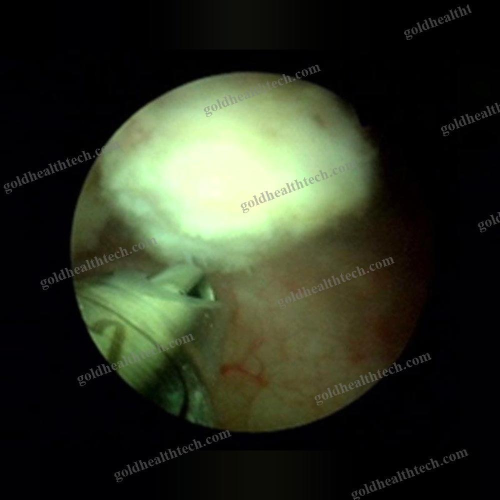 Surgical Laser