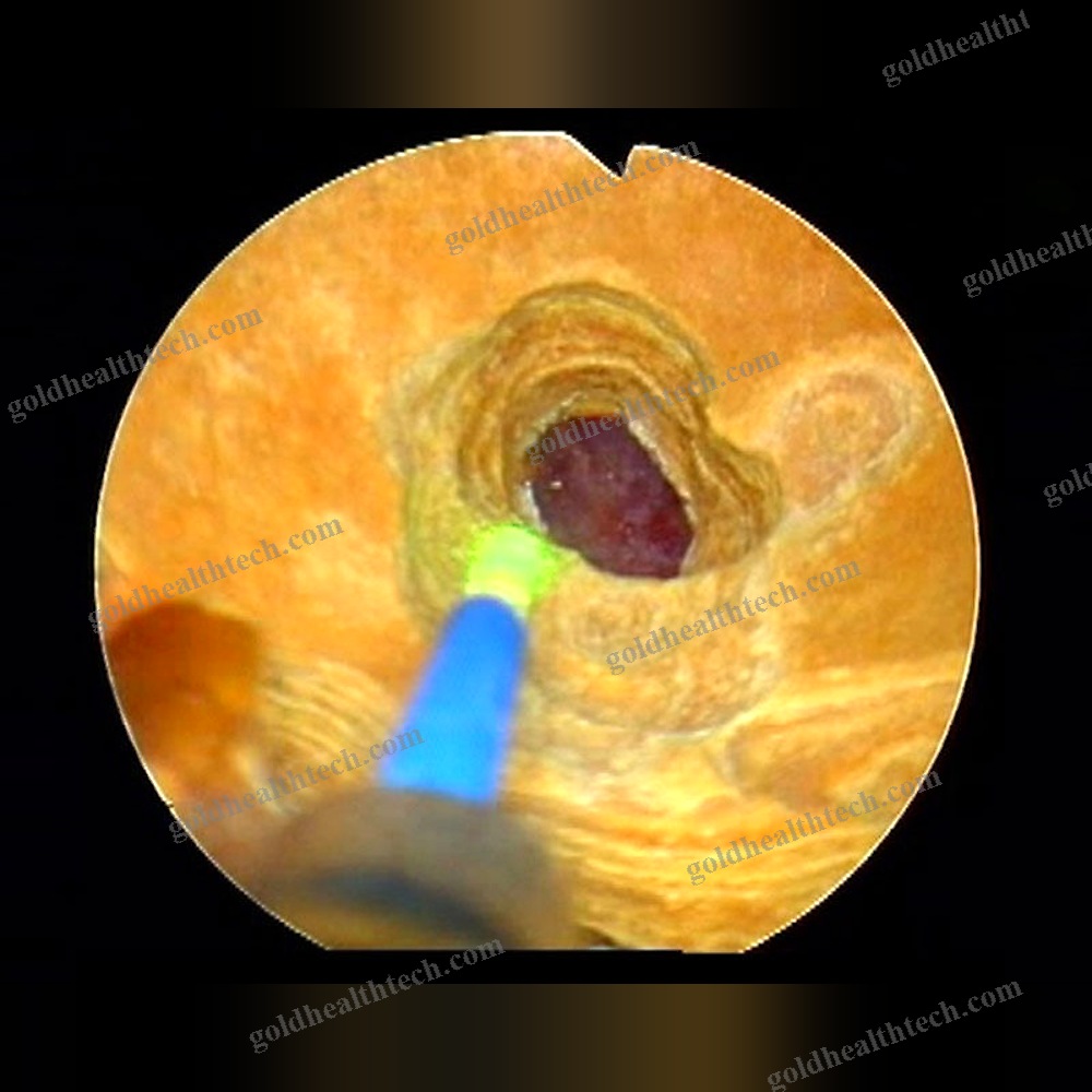 Surgical Laser