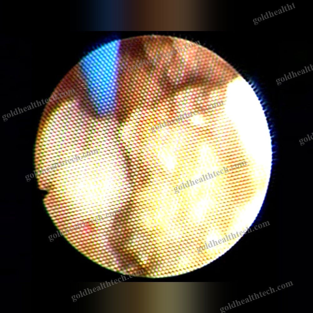 Surgical Laser