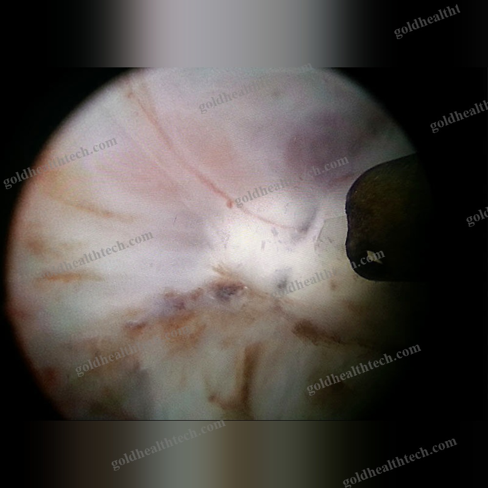 Surgical Laser