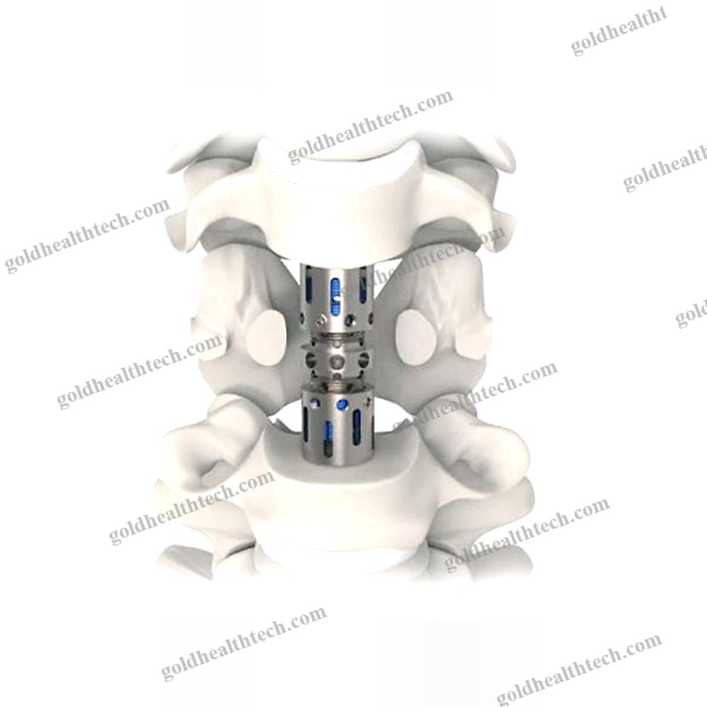 Cervical Vertebral Corpectomy Prosthesis