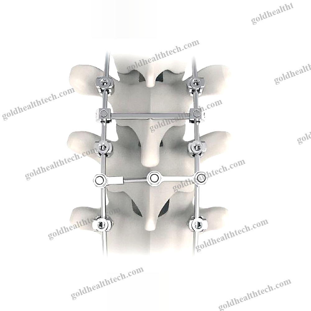 Thoraco-Lumbar Osteosynthesis Unit