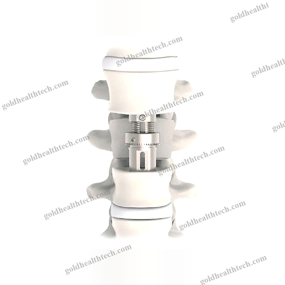 Thoraco-Lumbar Vertebral Corpectomy Prosthesis