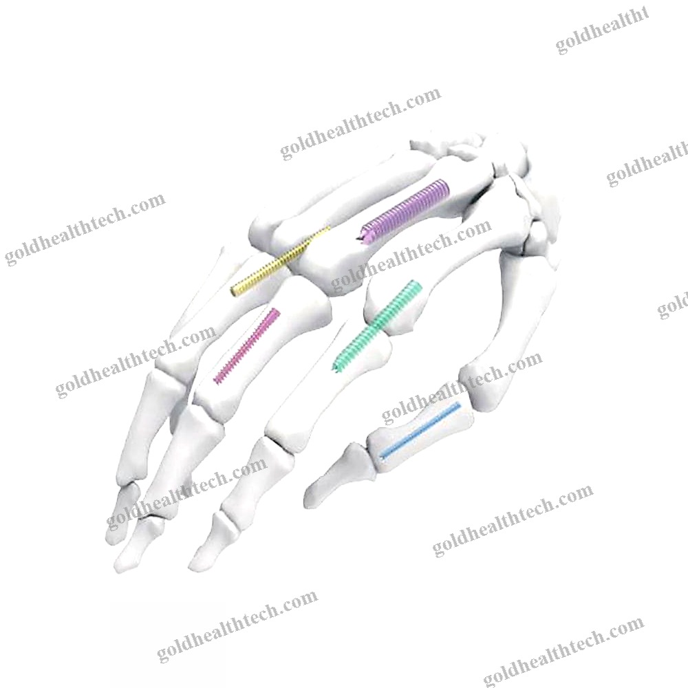 General Purpose Compression Bone Screw