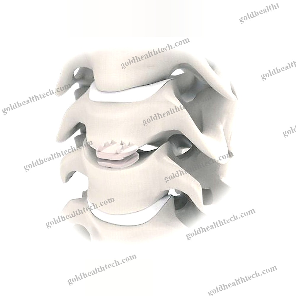 Cervical Disc Prosthesis