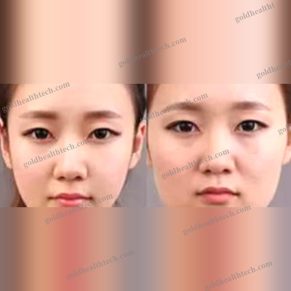 Hair Removal Ipl System