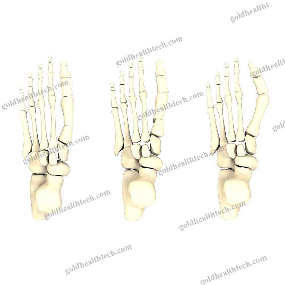 Hallux Valgus Arthrodesis Plate