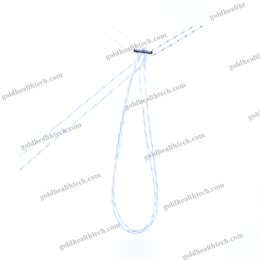 Acl Reconstruction Suture Button