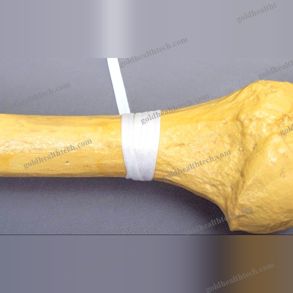 Hip Revision Surgery Bone Cerclage Wiring