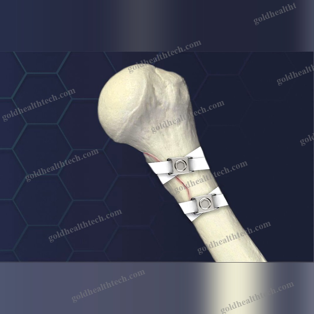 Hip Revision Surgery Bone Cerclage Wiring