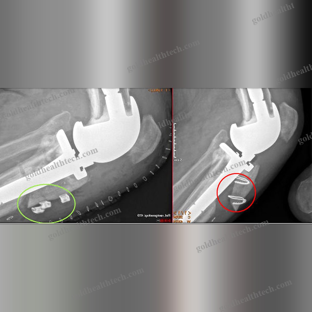 Hip Revision Surgery Bone Cerclage Wiring