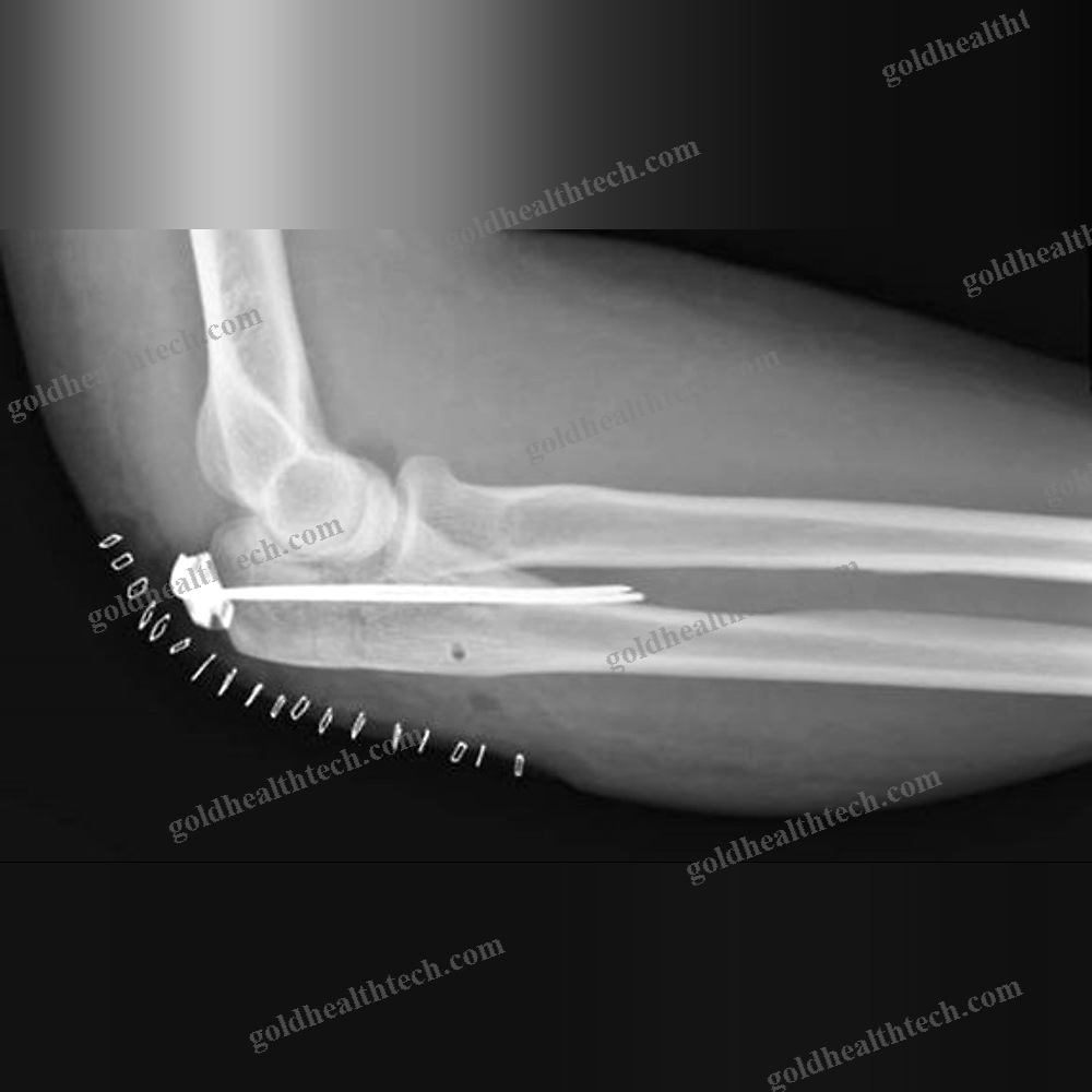 Hip Revision Surgery Bone Cerclage Wiring