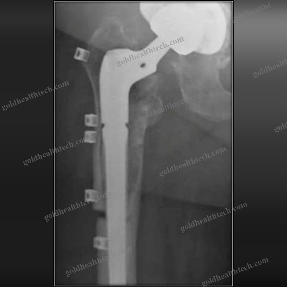 Hip Revision Surgery Bone Cerclage Wiring